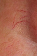 Thread veins