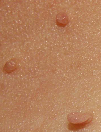 Skin tag