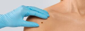 Mole on the skin